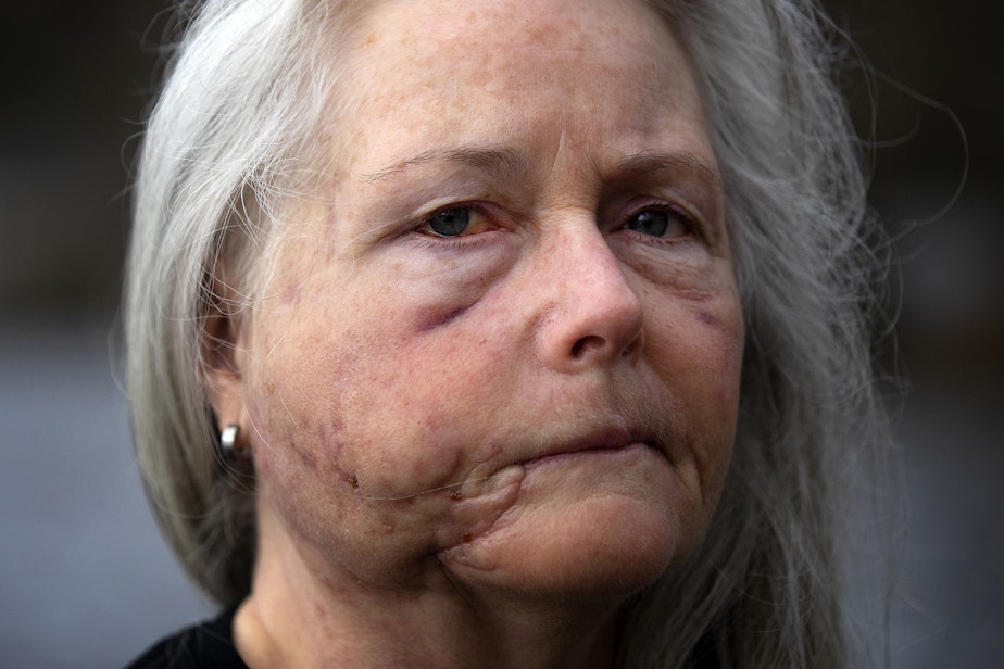 caption: Keri Bergere, a survivor of a cougar attack, is portrayed on Wednesday, March 13, 2024, at Log Boom Park in Kenmore.