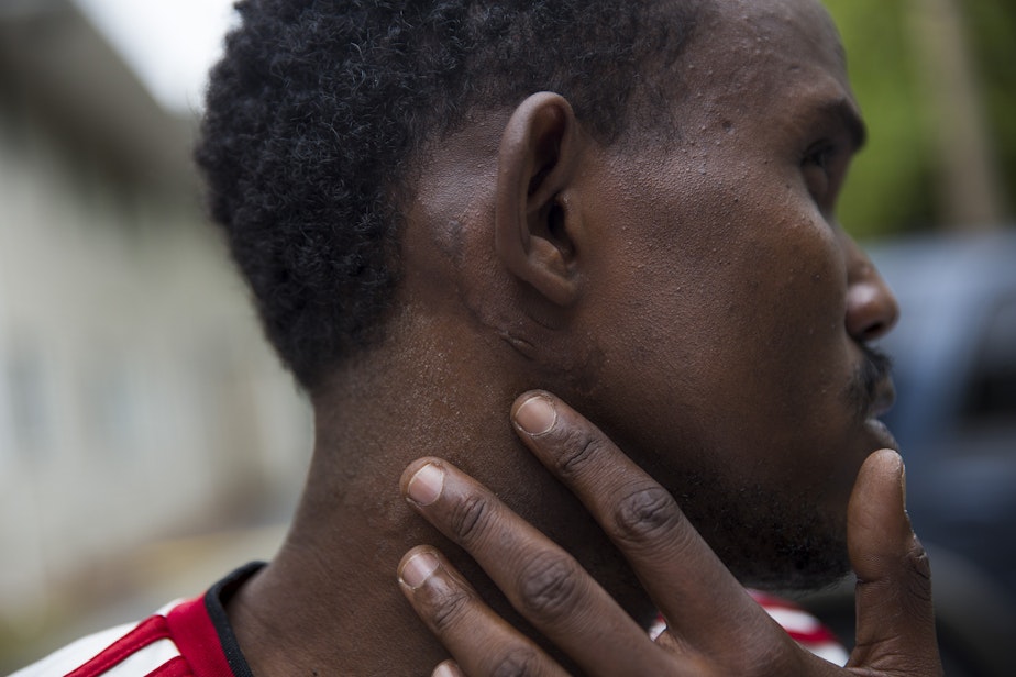 caption: Osman doesn't know the story behind his scar. His mother won't tell him. But he knows that at the same time he sister was raped and killed.